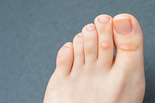 Corns Can Be In Two Places on the Foot