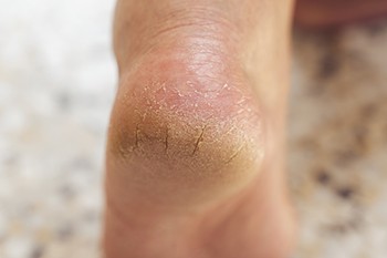 Understanding Diabetic Heel Fissures