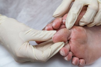 Diabetic Foot Care