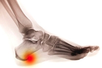 A Heel Spur May Be Misdiagnosed